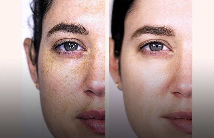 les Taches Brunes et l'Hyperpigmentation